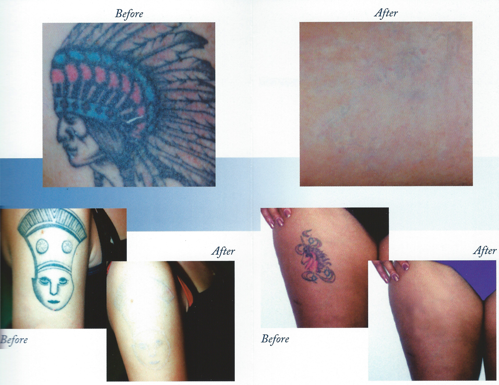 Laser Tattoo Removal Skin Iowa Cosmetology Dermatology Des Moines