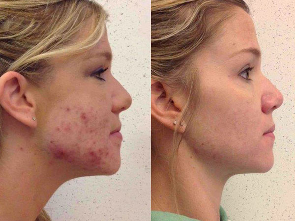 Acne Treatments | Skin Iowa Cosmetology Dermatology Des Moines