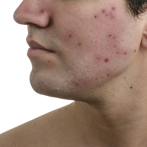 Severe acne videos ✨ removal Causes of