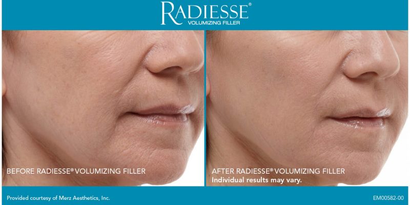 radiesse4